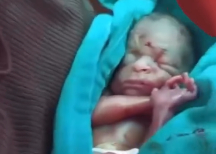 Bebê prematuro sobrevive após ser dado como morto em maternidade